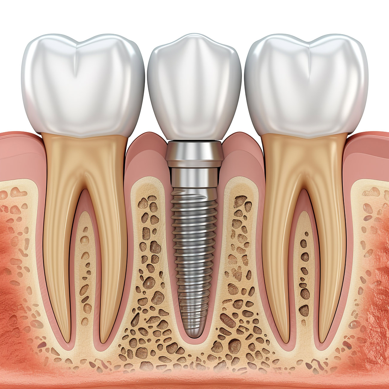 aktif dent implant AKTİF DENT www.aktifdent.com.tr info@nederlands.com.tr 05399280551